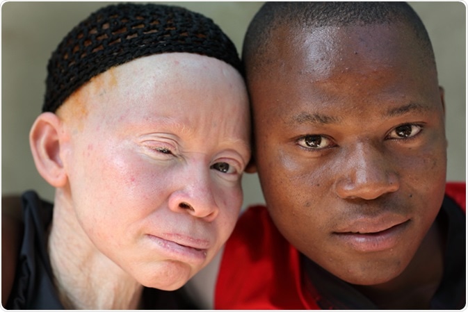 People with albinism worry about Covid-19